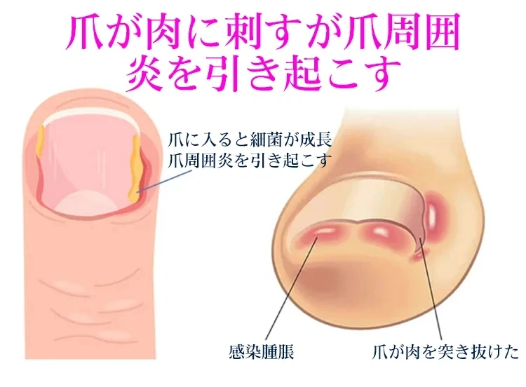 Jaysuing 抗甲溝緩解油