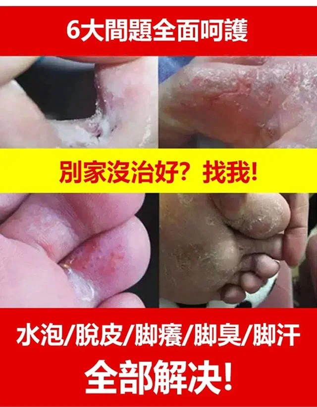 草本止癢去腳氣膏