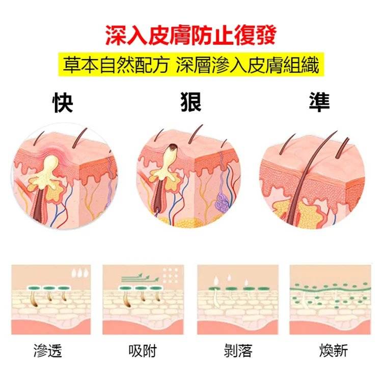 日本讃諾克克尤膏，治療病毒疣藥膏