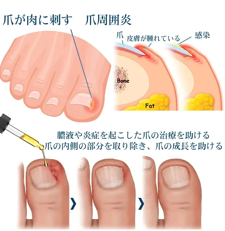 Jaysuing 抗甲溝緩解油