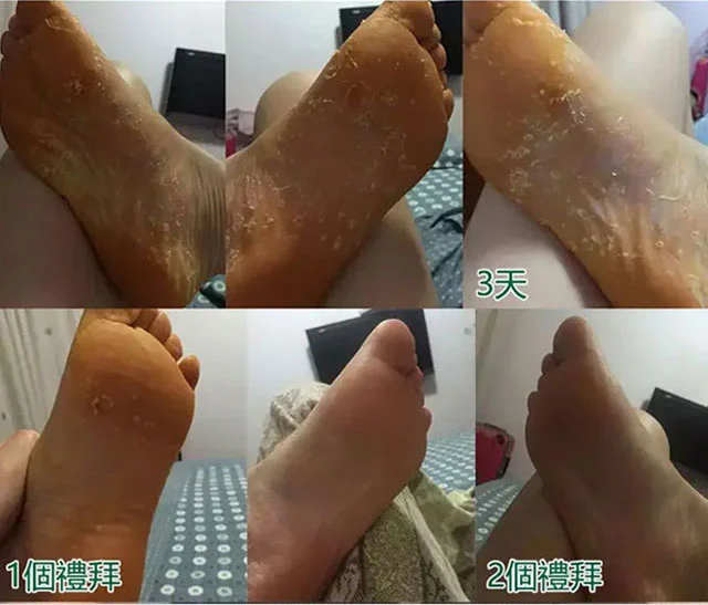 草本止癢去腳氣膏