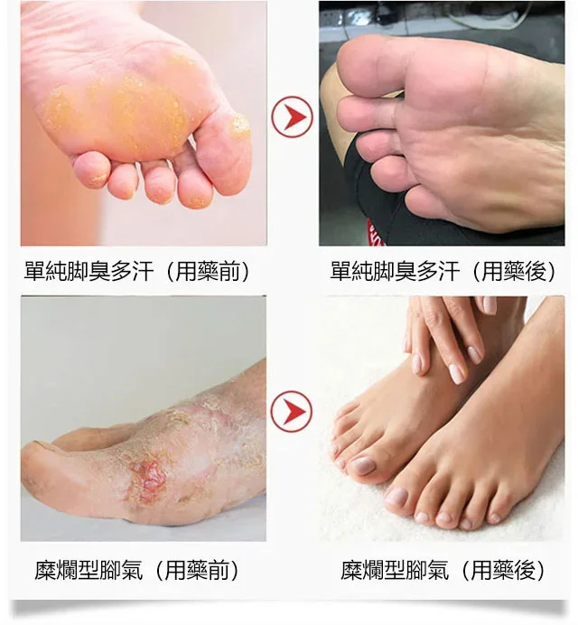 草本止癢去腳氣膏