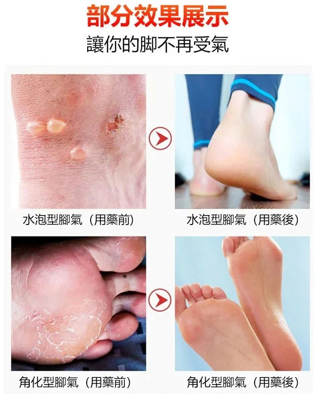 草本止癢去腳氣膏