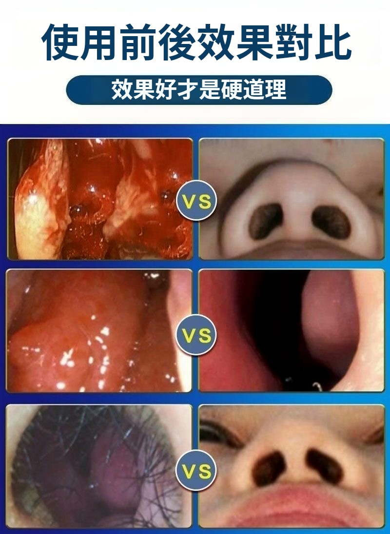 日本特效鼻炎噴霧