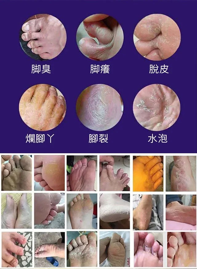 草本止癢去腳氣膏